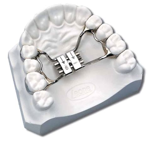 rapid palate expander  orthodontics archwired