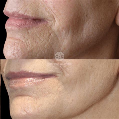 fractional rf secret rf cosmetic sculpting