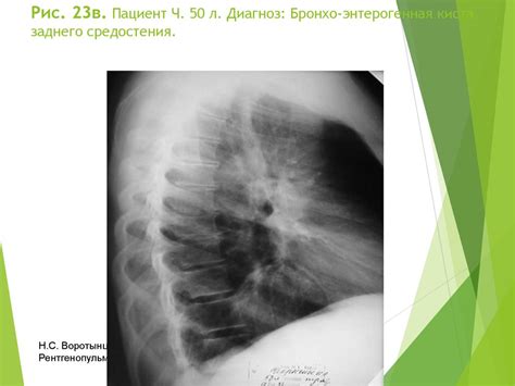 Синдром круглой тени - презентация онлайн