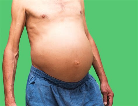 Quais são os tratamentos para a ascite? - Dr. Douglas Bastos – Cirurgia ...