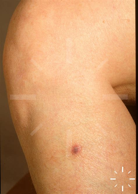DermaCompass - Dermatofibrom, Histiozytom, DF