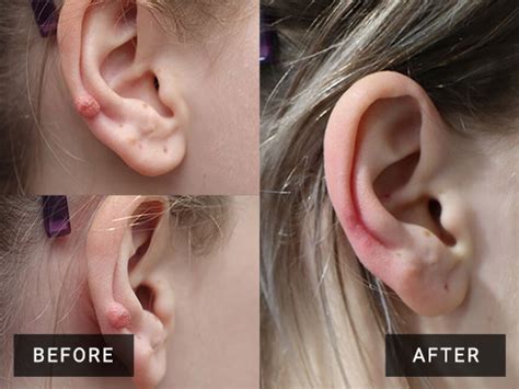 Hypertrophic Scar Piercing
