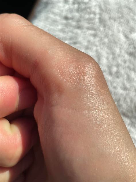 Tiny warts on my hand? : r/Warts