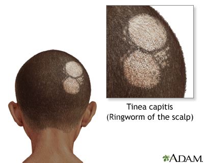 Ringworm of the scalp - UF Health