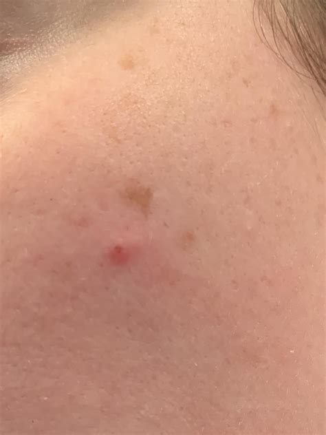 What I thought was a freckle is now raised after being flat for years