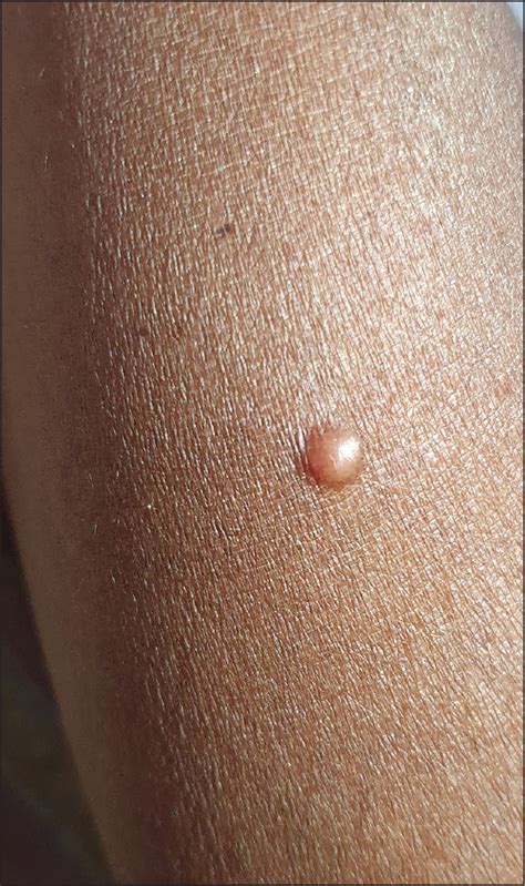 caught  fingerprint dermoscopy  solitary neurofibroma pmc