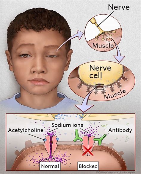 penyakit myasthenia gravis perumperindocoid