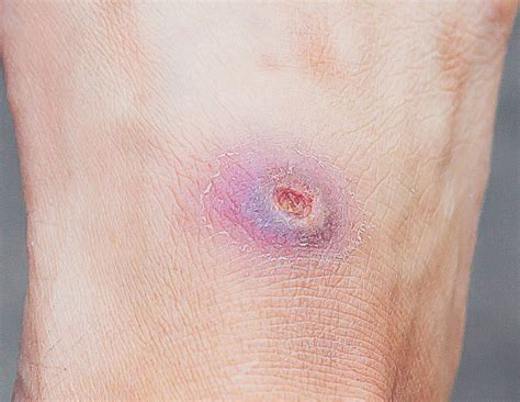 Diabetic Foot Ulcers | AMERIGEL Advanced Skin & Wound Care