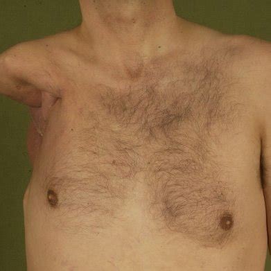 Postoperative aspect after extended shoulder disarticulation for ...