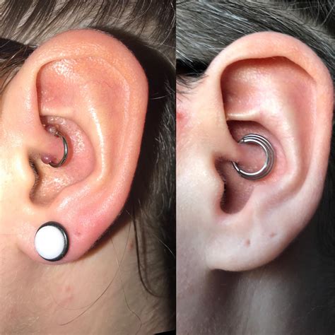 Hypertrophic Scar Vs Keloid Piercing Piercing Bump Treatment Bump