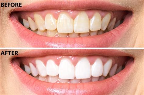 teeth whitening dant suraksha dental care