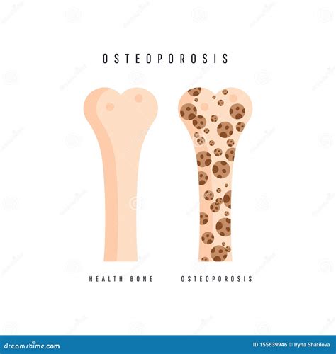 Illustration of Osteoporosis Bone and Healthy Bone Stock Illustration