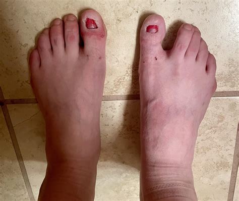 Yesterday I had both big toenails permanently removed : r/Ingrown_Toenails
