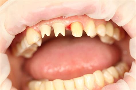 Циркониевые коронки на имплантах и коронка E-max | Dentistry