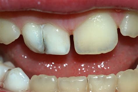 Everything You Need to Know About Tooth Germination - Oris Dental Center