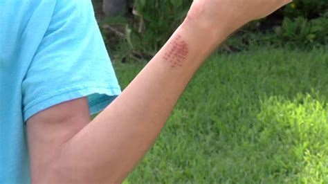 Venomous caterpillar sends teenager to hospital - ABC13 Houston