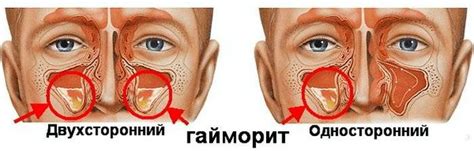 Гайморит мкб-10 код: хронический двухсторонний и гнойный синусит у ...