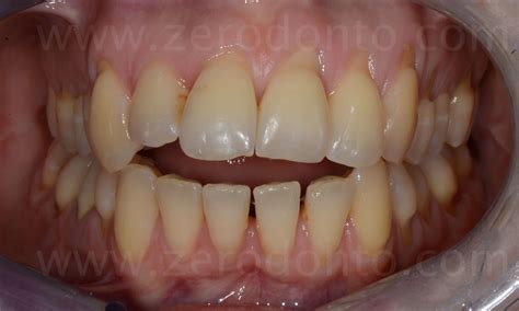 Severe Overbite Side View