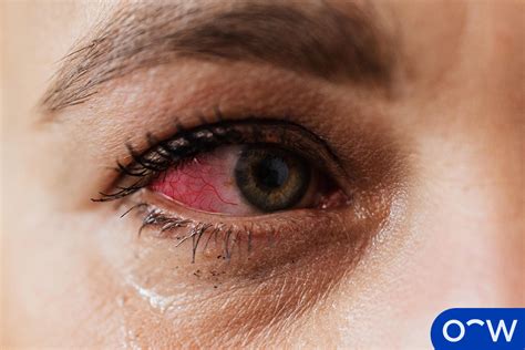 Pink Eye (Conjunctivitis): Symptoms, Causes, and Treatment