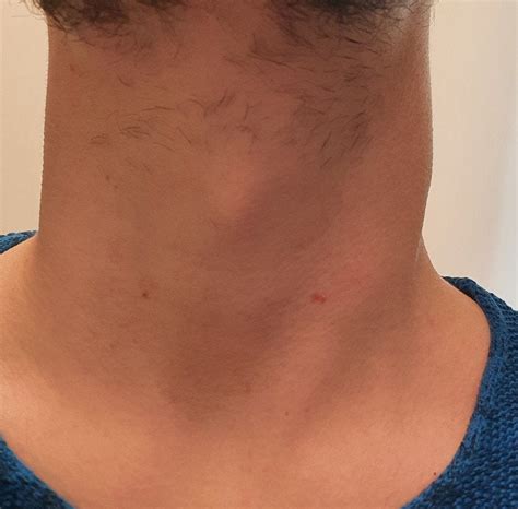 Neck lump - anyone knows what this is? : r/AskDocs