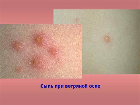 Бледность кожных покровов у ребёнка с гемофилией