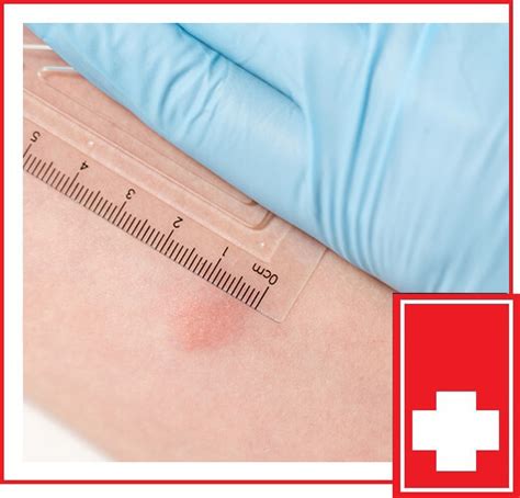 What Does A Positive TB Skin Test Look Like?, 53% OFF