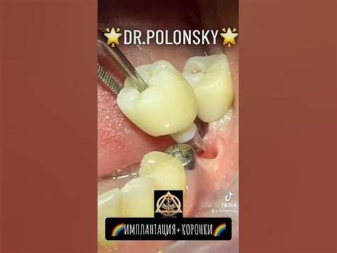 Стоматолог Одесса Доктор Полонский Стоматологія Одеса Вініри #Одеса # ...
