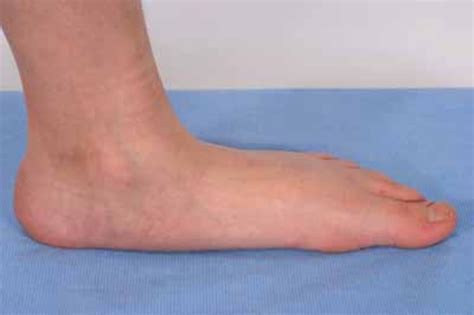 Charcot-Marie-Tooth disease: MedlinePlus Genetics