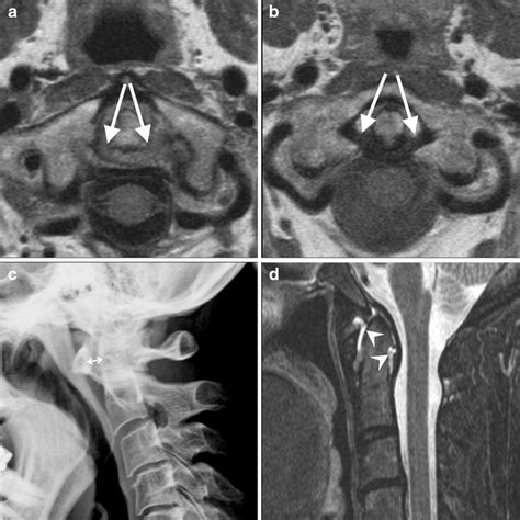 MRI of the transverse and alar ligaments in rheumatoid arthritis ...