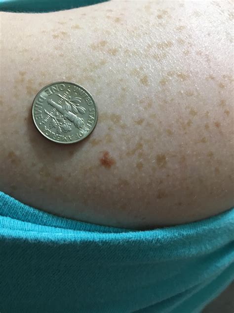 (27F) Noticed this reddish/light-brown spot ~3 weeks ago on shoulder