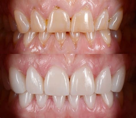 veneers wanneroo dental centre