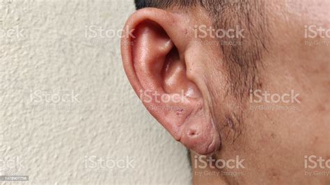 The Ear Lobe And Inflammation Skin Dermatitis Of The Ear Stock Photo - Download Image Now - iStock