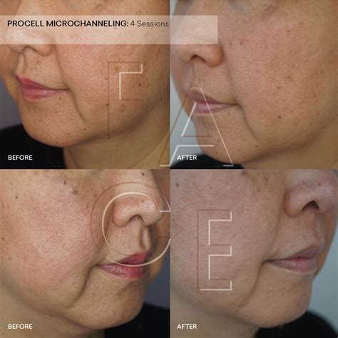 Procell Microchanneling Before and After — FACE