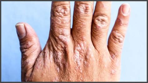 Shingles on hands pictures | Shingles Expert