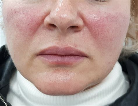 Розацеа - как не пропустить начало заболевания и как ухаживать за кожей ...