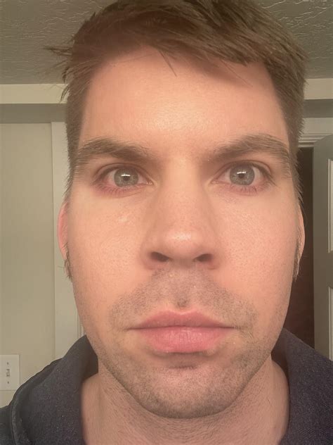 Has anyone ever fixed red/puffy eyelids? Started happening 8 years ago