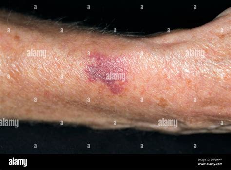 purpura  res stock photography  images alamy