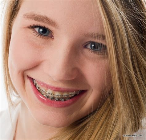 Cute Braces Colors For Teens