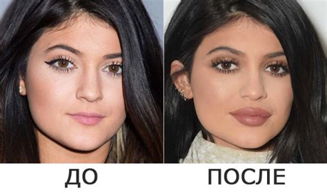 Коррекция ягодиц филлерами до и после фото
