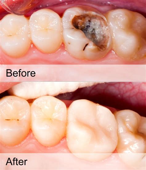 List 101+ Pictures Pictures Of Cavities In Teeth Completed