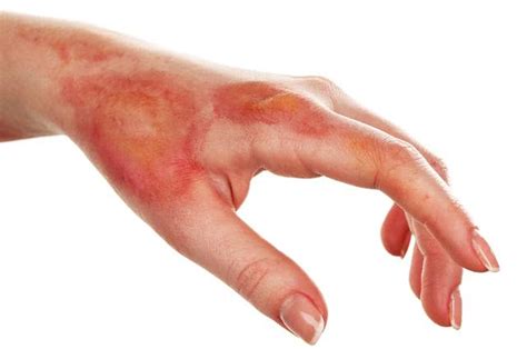 Queimadura Com Água Quente Na Mão O Que Fazer - Como Tratar as Queimaduras | Saúde – Blog OPAS