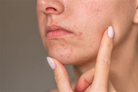 stages  perioral dermatitis healing  dermatology partners
