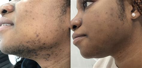 Laser Hair Removal Before And After Pcos at Austin George blog