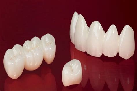rang su zirconia   loai cach lua chon mao su zirconia phu hop