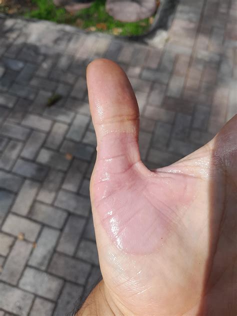 Help! Hand Shedding : r/DermatologyQuestions