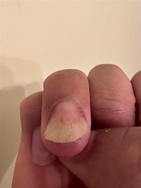 Fingernail issues : r/DermatologyQuestions