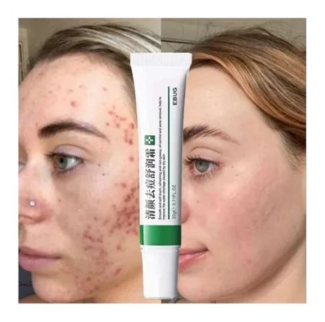 Melhor Pomada Para Acne - Pomada Creme Removedor Clareador Manchas Acne Sardas 20g Momento de ...