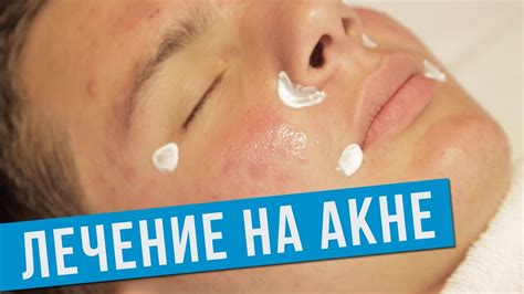 Лечение на Акне - Д-р Весела Райкова - Aesthe Clinic Beauty - YouTube