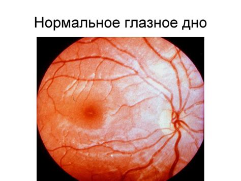 Постепенная потеря зрения - презентация онлайн