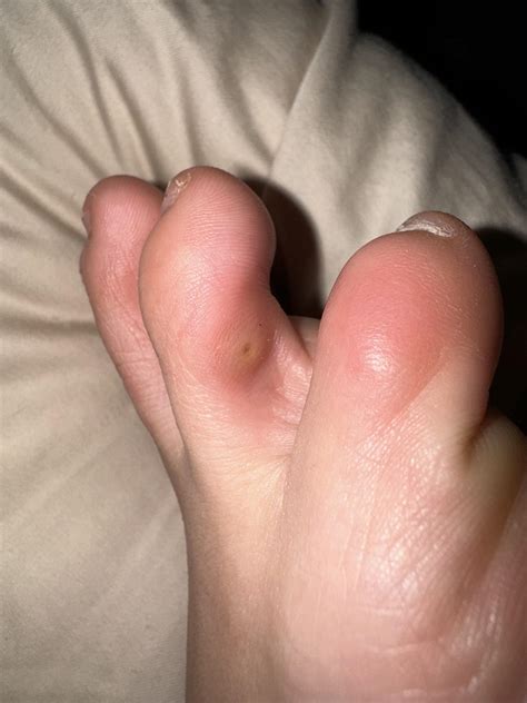 weird blister/sore between toes : r/FootFunction